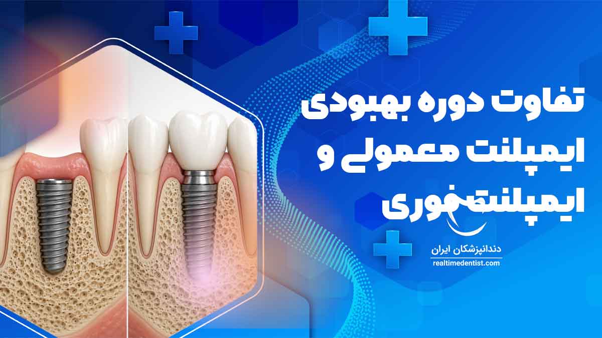 مراحل بهبودی ایمپلنت دندان