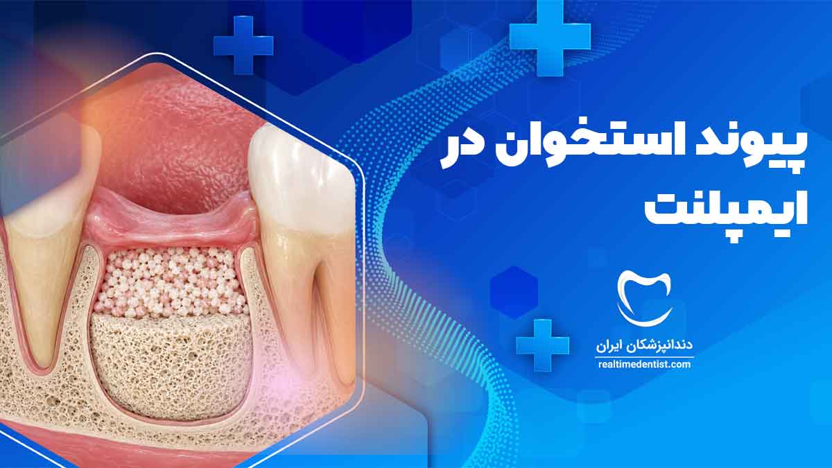 مراحل بهبودی ایمپلنت دندان