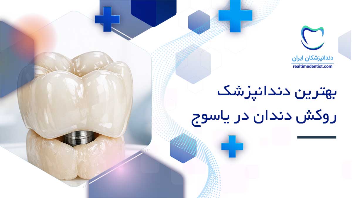 بهترین دکترهای روکش دندان در یاسوج
