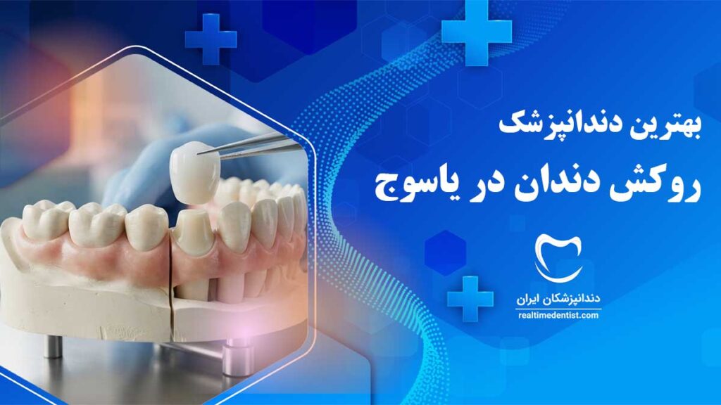 بهترین دکترهای روکش دندان در یاسوج