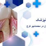 عصب کشی دندان در محمدشهر کرج