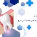 جراحی دندان نهفته در محمدشهر کرج