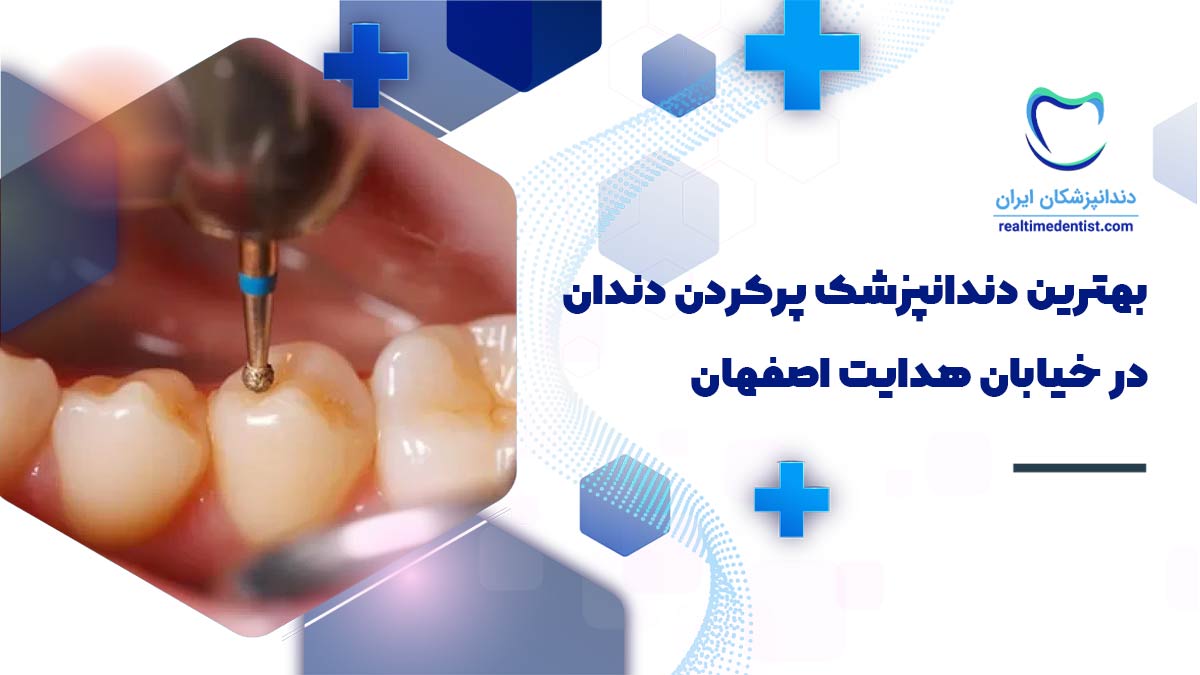 پرکردن دندان در خیابان هدایت اصفهان