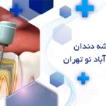درمان ریشه دندان در خانی آباد نو تهران