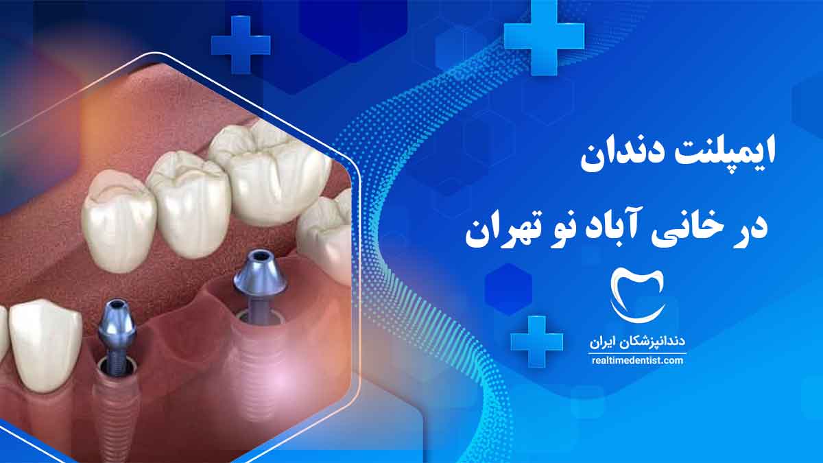 ایمپلنت دندان در خانی آباد نو تهران
