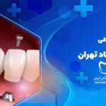 بهترین مرکز ایمپلنت دندان اقساطی در عبدل آباد تهران