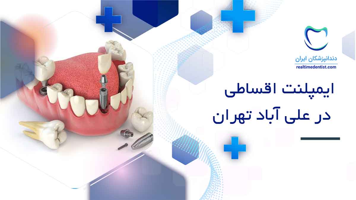دندانپزشک متخصص ایمپلنت اقساطی در علی آباد تهران