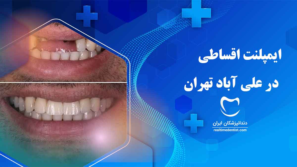 دندانپزشک متخصص ایمپلنت اقساطی در علی آباد تهران