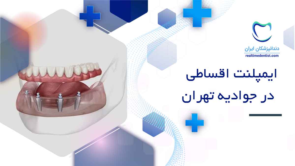 متخصص ایمپلنت اقساطی در جوادیه تهران