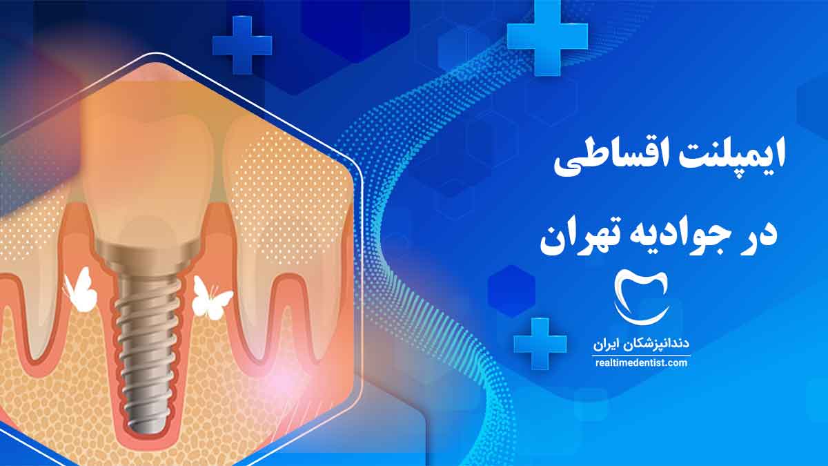 متخصص ایمپلنت اقساطی در جوادیه تهران