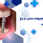 دندانپزشک ایمپلنت دندان در باغ فردوس تهران
