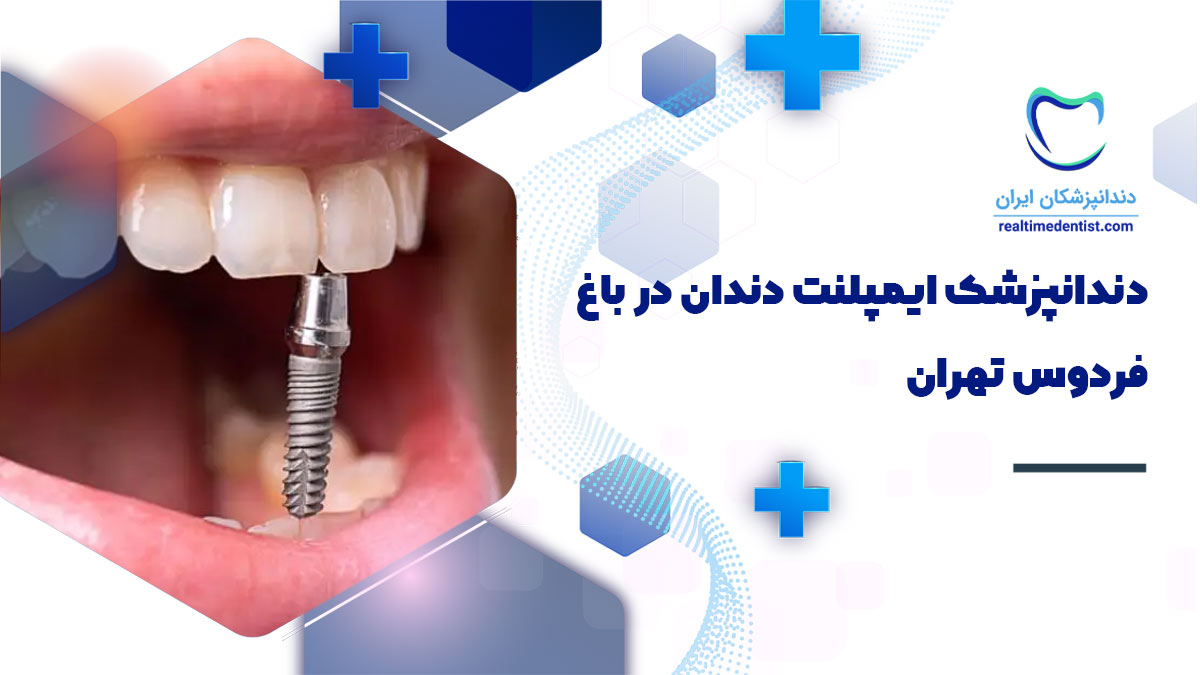دندانپزشک ایمپلنت دندان در باغ فردوس تهران