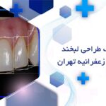 طراحی لبخند دیجیتال در زعفرانیه تهران